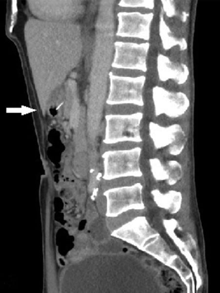 Australian Man Swallows Metal Bristle from Barbecue Brush